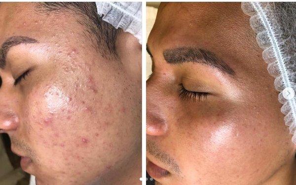 Before and After 6 Acne Facials