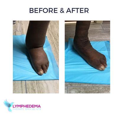 Lymphedema Therapy Specialists