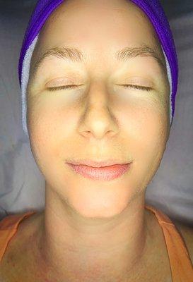 After facial and microdermabrasion