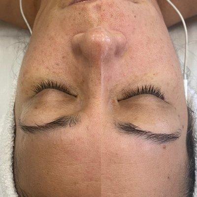 Microdermabrasion with pumpkin enzyme peel! Noticeable reduction of spots and forehead lines