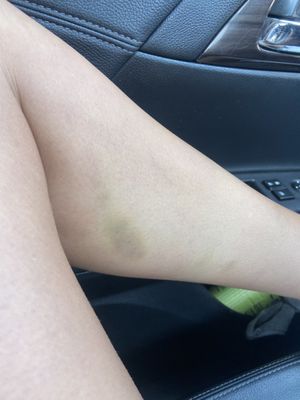 Bruises from the massage