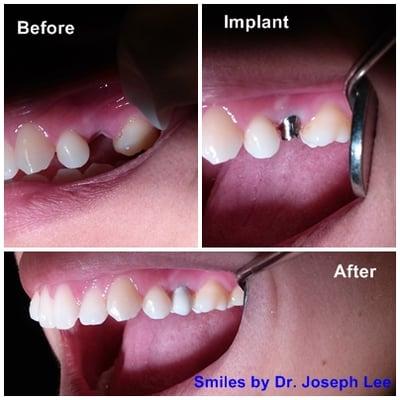 Implant and Crown, under $2000 !!!