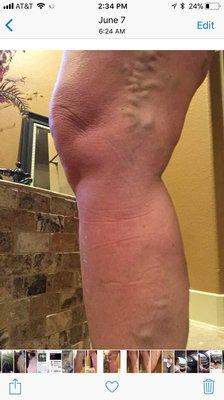 Before Vein Solutions