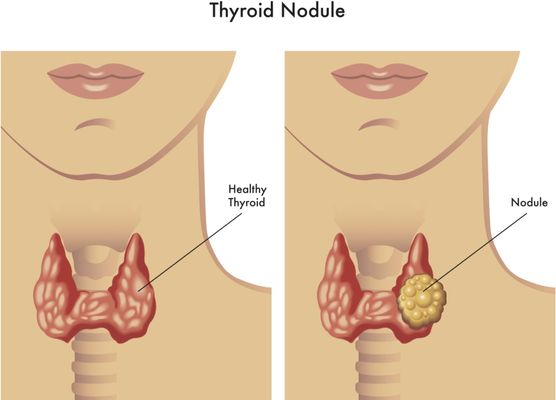 Difference between healthy thyroid and inflamed