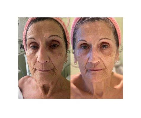 Look what just a series of 3 Korean "no needle" filler facials can do!