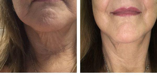 Skin texture and wrinkle reduction using Le Mieux's EGF (Epidermal Growth Factor) Serum