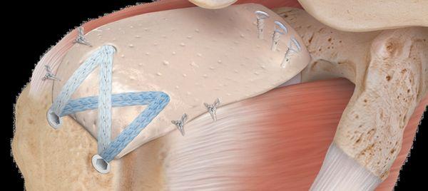 Superior Capsular Reconstruction (SCR) can restore kinematics and decrease pain from an irreparable rotator cuff tear.