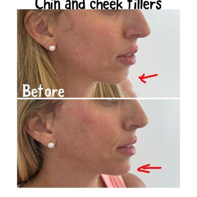 Chin fillers and PDO threads