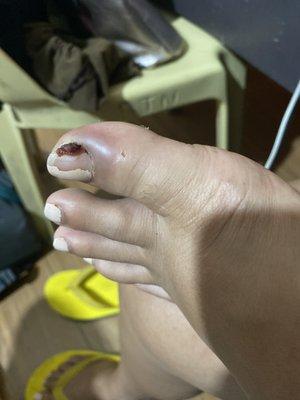 Worsening ingrown infected toenail