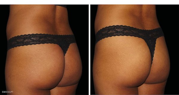 Emsculpt to lift and tone the buttocks