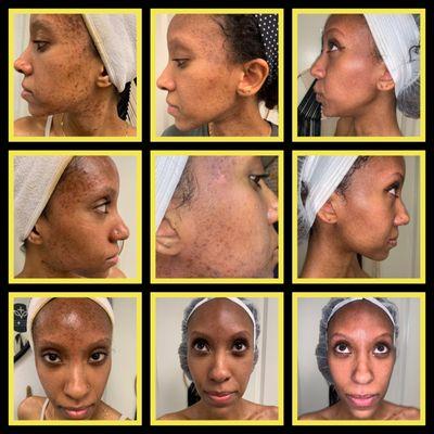 Facial Microneedling Series