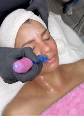 MICRONEEDLING FACIAL TREATMENT