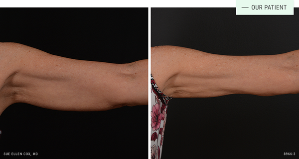 One CoolSculpting treatment to the arms