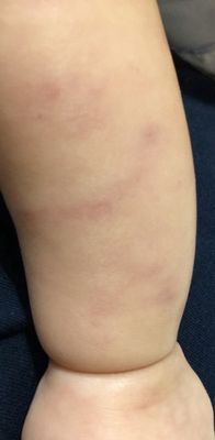 Bruising from medical staff holding down an infant (more pics taken as notes for experience)