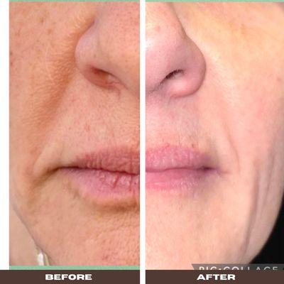 FIBROBLAST skin tightening of upper lip, nasolabial folds, outer lip jowl