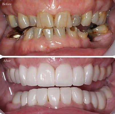 Full mouth reconstruction with crowns, bridges, implants and veneers