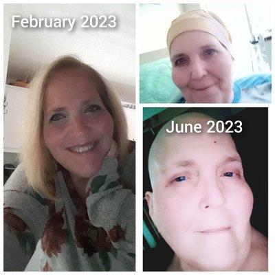 Before pic Feb 2023 when I received my terminal cancer diagnosis. Last picture June 2023.