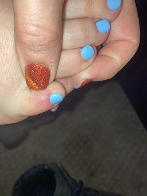 Sore healing cut by cuticle