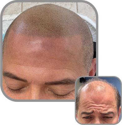 Scalp Micropigmentation New Jersey Hair Tattoo Before & After