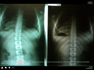 scoliosis correction