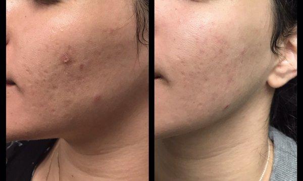 Before and after - one session of Microneedling with PRP