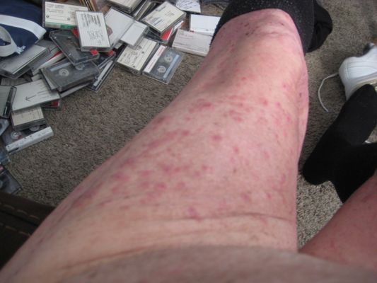 This is severe hives if I'm to believe the diagnosis I was given. The worst thing to happen to me in 70 years. I had to call them 6 times in