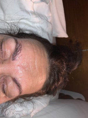 Botched Microblading Results