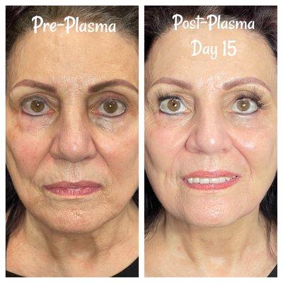 PlasmaPen Skin Tightening & Rejuvenation