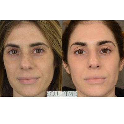 Photo to the left is before our medium medical grade chemical peel and photo to the right is just 4 weeks after one peel