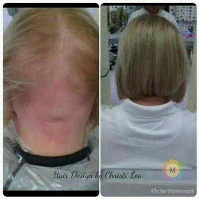 Before and after hair extensions to cover her baldness.