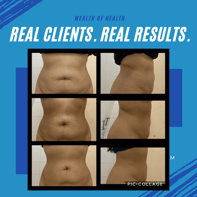 Verju Laser Treatment does work! this Patient is killing it with her sessions and diet package.