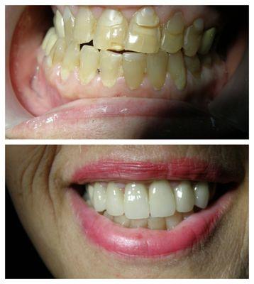 Before (top) and After (bottom) all porcelain crowns.