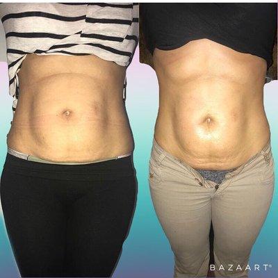 Results after only 4 sessions. She also contoured her torso using a waist trainer consistently.