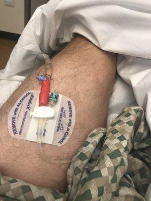 Long term catheter after surgery