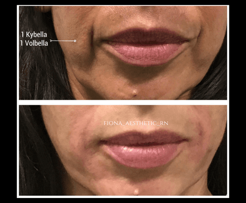 Kybella on the face. Permanent results!