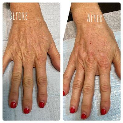 Radiesse hand treatment