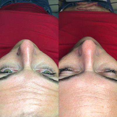 Derma peel before and after pictures