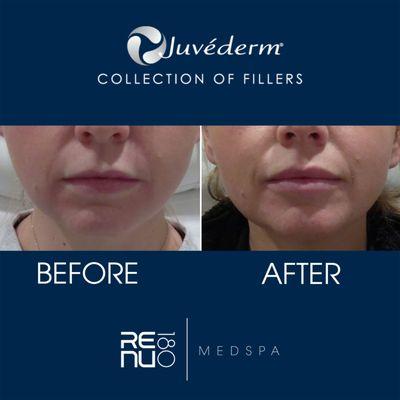 #Juvederm Results!