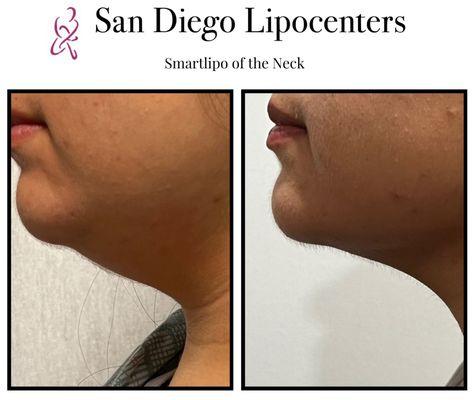 SmartLipo of neck