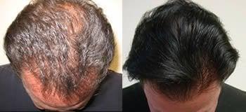 Stop Your Hair Loss