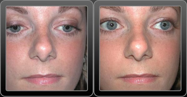 Rhinoplasty Before & After