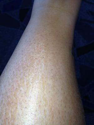 My leg 5 days after spray tan, looks terrible!