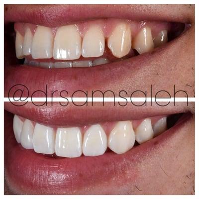 Treatment of NO PREP veneers to close gaps between teeth. No drilling, No shots, No pain.