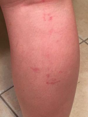 More swollen, bruises, and broken blood vessels on my legs. They started to appear 24 hours after and became very painful.