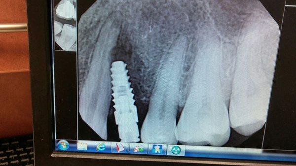 Affordable Dentures & Implants