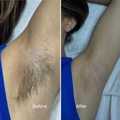 underarm wax before and after