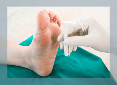 Neuropathy testing at Weil Foot & Ankle Institute