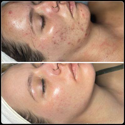 Acne skin revision. Let us help you gain confidence from the inside out.