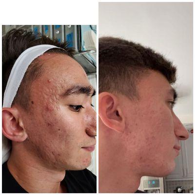 VI peel purify one treatment results. This peel designed to target acne