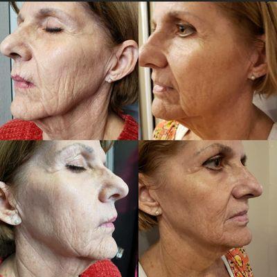 Microneedling side shotsafter 1 session